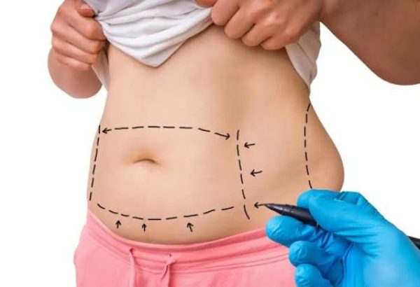 Why Does Tummy Tuck Surgery Cost Differ Between Patients?