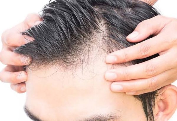 How Does Hybrid Hair Transplant Work?